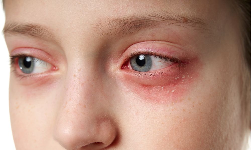 Alergiczne Choroby Oczu Jak Je Rozpozna I Leczy OneDayClinic Alergiczne Choroby Oczu Jak Je Rozpozna I Leczy OneDayClinic